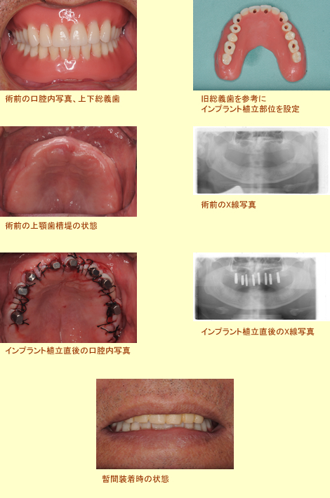 難症例インプラント手術